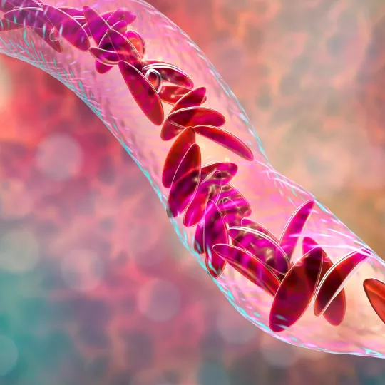 Sickle cell disease